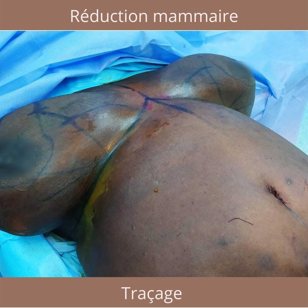 tracage reduction mammaire clinique du centre