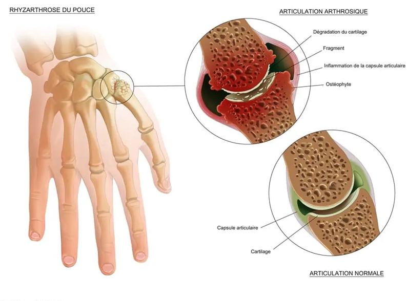 clinique du centre arthrose de pouce 