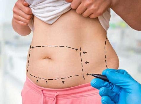 liposuccion avec abdominoplastie