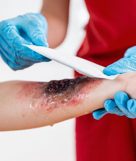Clinique du Centre - Chirurgie des brûlures