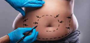 La graisse abdominale : Obtenir un corps mince grâce à la liposuccion