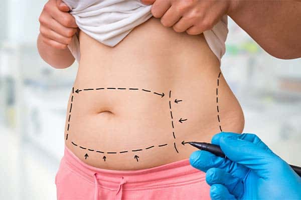 liposuccion ventre avant apres prix liposuccion abdominale dr alexandre bouhanna chirurgien esthetique paris est vincennes docteur alexandre bouhanna avis tarif